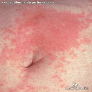 Аллергические высыпания на коже у взрослых