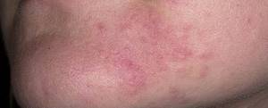 Как лечить аллергический дерматит у взрослых