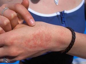 Аллергия на герань как проявляется