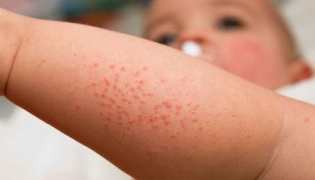 Аллергия на водопроводную воду у ребенка