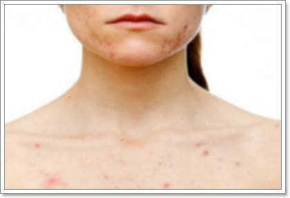 Аллергия атопический дерматит