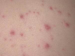 Красные точки на теле аллергия
