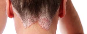 Аллергия на голове в волосах