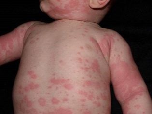 Аллергические высыпания у детей