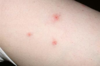 Как выглядит укус комара