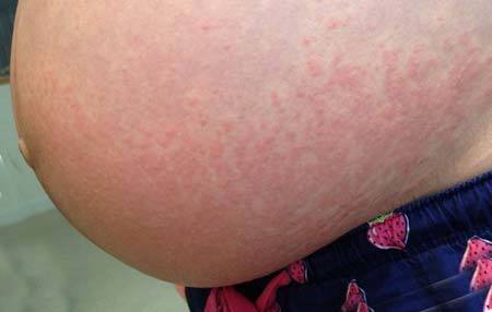 Чем лечить аллергию у беременных