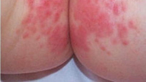Аллергия на цветную капусту у грудничка