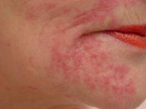 Мазь от аллергии на лице