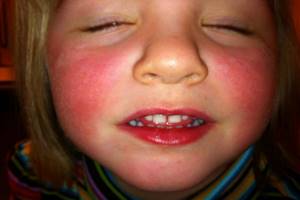 Аллергия на перьевые подушки