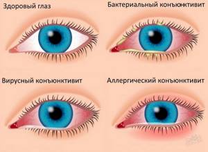 Аллергия капли в глаза
