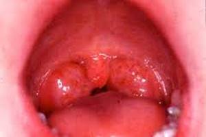 Может ли болеть горло при аллергии