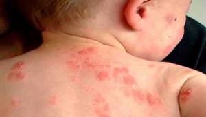 Аллергия в виде бляшек