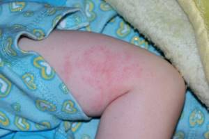 Аллергия на руках у ребенка