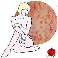 Красные точки на теле аллергия