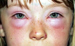 Капли в глаза при аллергии