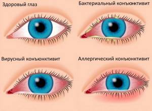 Глазные капли при аллергии