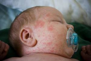 Средство от аллергии для новорожденных