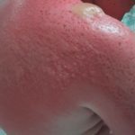 Что делать при аллергии на солнце
