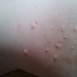 Как выглядит аллергическая сыпь у детей