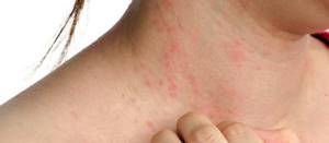 Аллергия на огурцы у взрослых