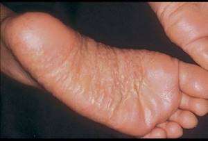 Контактный дерматит на ногах