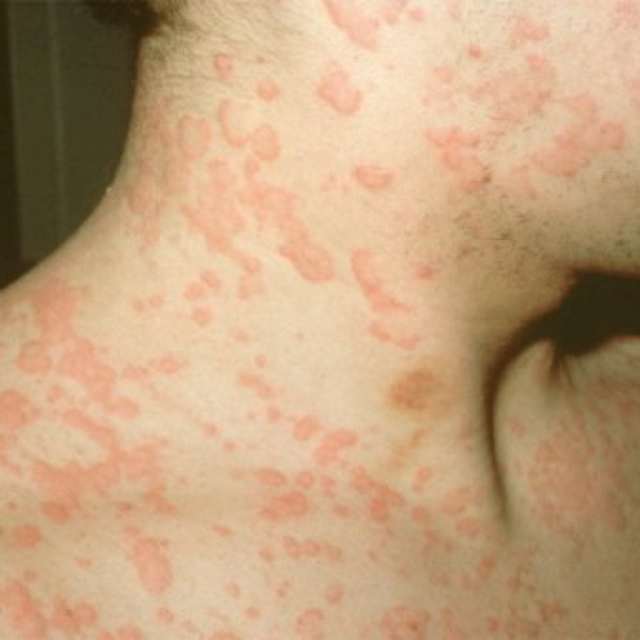 Пищевая аллергия на лице у взрослых