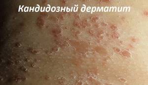 Кандидозный дерматит у взрослых