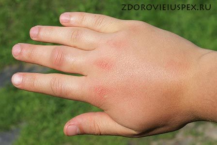 Аллергия от укусов насекомых