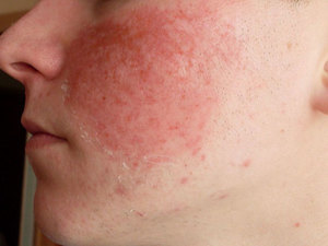 Аллергия на шерсть как проявляется