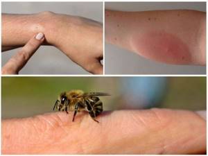 Как выглядит аллергия на руках
