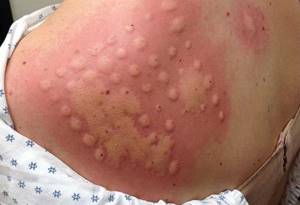 Аллергия на лейкопластырь волдыри