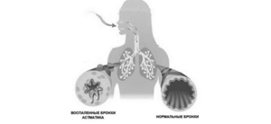 Ингалятор астма