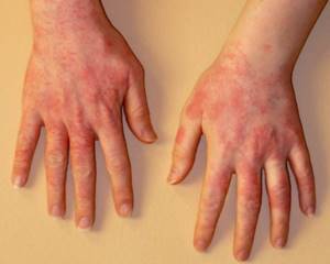 Средство от аллергии на руках