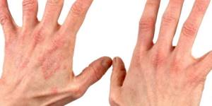 Мазь от контактного дерматита на руках