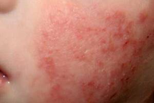 Токсико аллергический дерматит