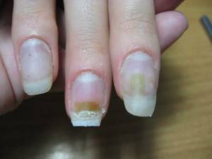 Аллергия на наращивание ногтей