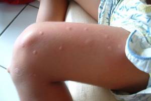 Аллергия на коже как укусы комаров