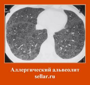 Аллергический альвеолит
