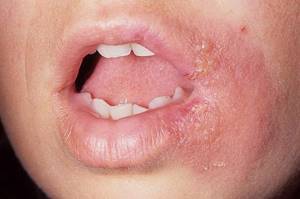 Аллергия на губах симптомы