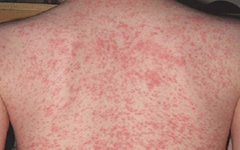 Лечение при аллергии кожи с зудом