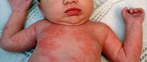 Аллергия у грудного ребенка