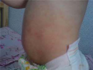 Аллергия у ребенка 2 года