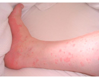 Аллергия у ребенка 5 лет