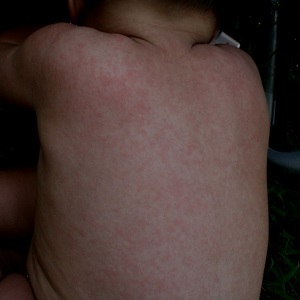 Аллергия на нурофен