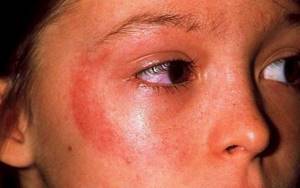 Признаки аллергии на солнце