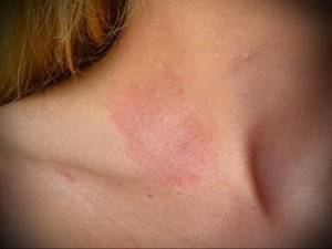 Аллергия на теле красные пятна
