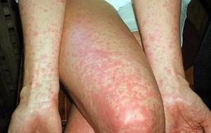 Аллергия высыпания