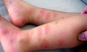 Средства против аллергии на коже