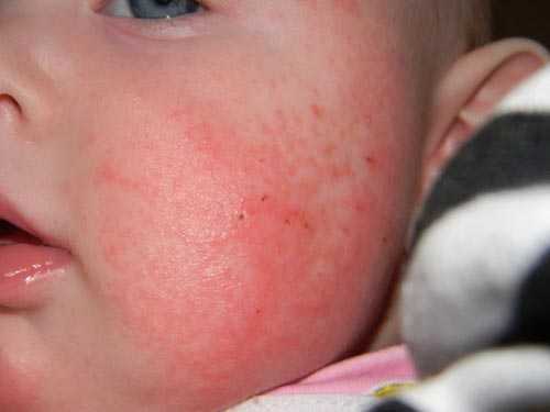 Аллергия на фруктозу симптомы у взрослых