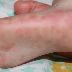 Аллергия на коже как лечить